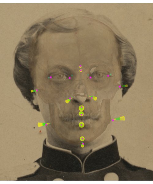 Visualization and analysis of soft tissue consistency through cones with Skeleton-ID in a positive match. For each cephalometric landmark (magenta), the cone region of the homologous craniometrics landmark in which it is located within the defined tissue study is visualized. We can see how, in the green stripe, the soft tissue thickness is between the mean ± the standard deviation (n’ – n, al’ L – al L, al’ R – al R, sn’ – ss, ls’ – pr, li’ – id, pg’ – pg, gn’ – gn). In the yellow stripe, above the mean plus three times the standard deviation (g’ – g) and below the mean minus three times the standard deviation (zy’ L – zy L, zy’ R – zy R, go’ L – go L, go’ R – go R). The pairs en’ – d and ex’ – ec have not been analyzed due to the lack of data in the statistical study