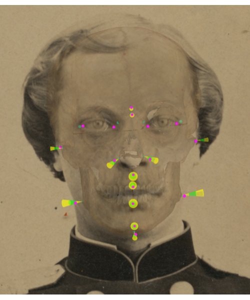 Visualización y análisis de la consistencia del tejido blando mediante conos con Skeleton-ID en un solapamiento positivo. Para cada punto cefalométrico (magenta), se visualiza la región del cono del punto craneométrico homólogo en la que se localiza dentro del rango definido en el estudio de tejido. Podemos ver cómo, en la franja verde, el tejido blando se encuentra entre la media ± la desviación estándar (n’ – n, al’ L – al L, al’ R – al R, sn’ – ss, ls’ – pr, li’ – id, pg’ – pg, gn’ – gn). En la franja amarilla, dentro de la media más tres veces la desviación estándar (g’ – g) y debajo de la media menos tres veces la desviación estándar (zy’ L – zy L, zy’ R – zy R, go’ L – go L, go’ R – go R). Las parejas en’ – d y ex’ – ec no se han analizado debido a la ausencia de datos estadísticos disponibles