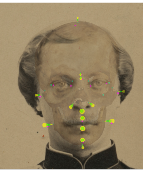 Visualización y análisis de la consistencia del tejido blando mediante conos con Skeleton-ID en un solapamiento negativo. Para cada punto cefalométrico (magenta), se visualiza la región del cono del punto craneométrico homólogo en la que se localiza dentro del rango definido en el estudio de tejido. Podemos ver cómo, en la franja verde, el tejido blando se encuentra entre la media ± la desviación estándar (al’ L – al L, al’ R – al R). En la franja amarilla, debajo de la media menos tres veces la desviación estándar (g’ – g, n’ – n, sn’ – ss, li’ – id, pg’ – pg, gn’ - gn) y fuera del rango del estudio (zy’ L – zy L, zy’ R – zy R, go’ L – go L, go´R – go R, ls’ – pr, v’ – v). Las parejas en’ – d y ex’ – ec no se han analizado debido a la ausencia de datos estadísticos disponibles