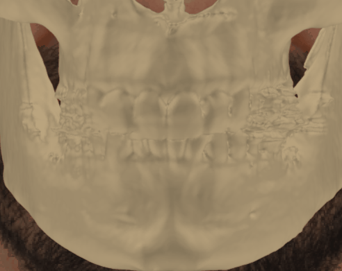 Ejemplo de un solapamiento positivo en la que se evalúa la consistencia dental con Skeleton·ID mediante la herramienta de transparencia, mostrando que los dientes superiores del cráneo encajan uno a uno con los dientes superiores de la fotografía de manera consistente. La herramienta de transparencia se ha utilizado para mostrar un gradiente de los dientes del cráneo superpuestos sobre los dientes de la fotografía