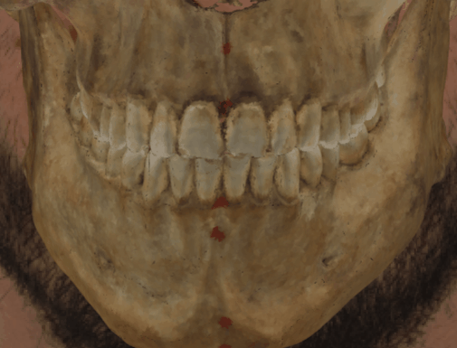 Ejemplo de un solapamiento negativo en la que se evalúa la consistencia dental con Skeleton·ID mediante la herramienta de transparencia, mostrando que los dientes superiores del cráneo no encajan uno a uno con los dientes superiores de la fotografía de manera consistente. La herramienta de transparencia se ha utilizado para mostrar un gradiente de los dientes del cráneo superpuestos sobre los dientes de la fotografía
