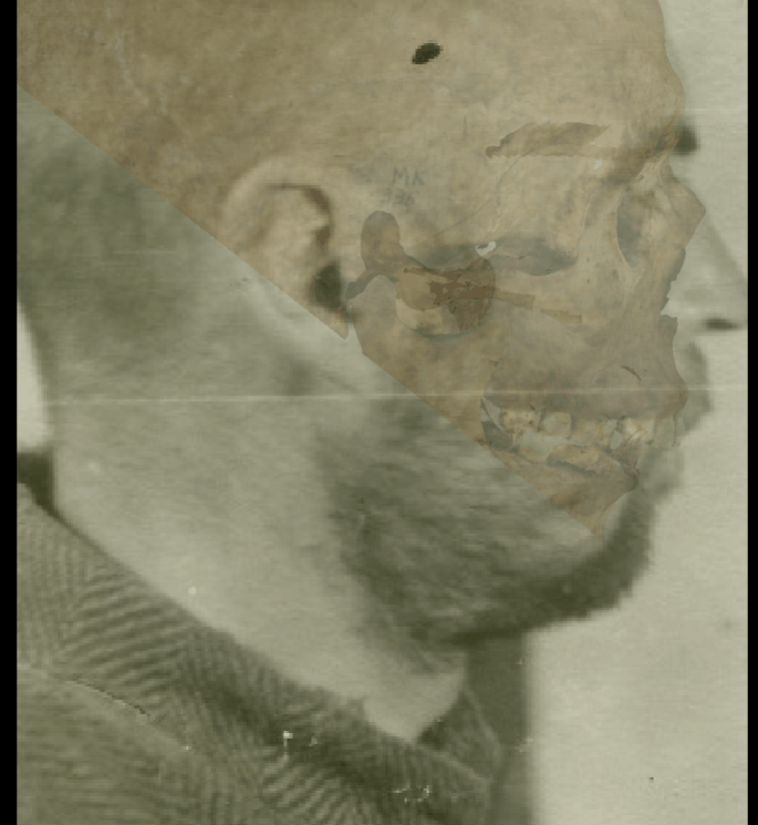 Example of a positive match in which the chin outline is evaluated with the transparency and wipe tools, showing that the chin outline is consistent with the mental outline. The wipe tool has been used to show a gradient from right to left (anatomical) of the mental outline (skull) over the chin outline