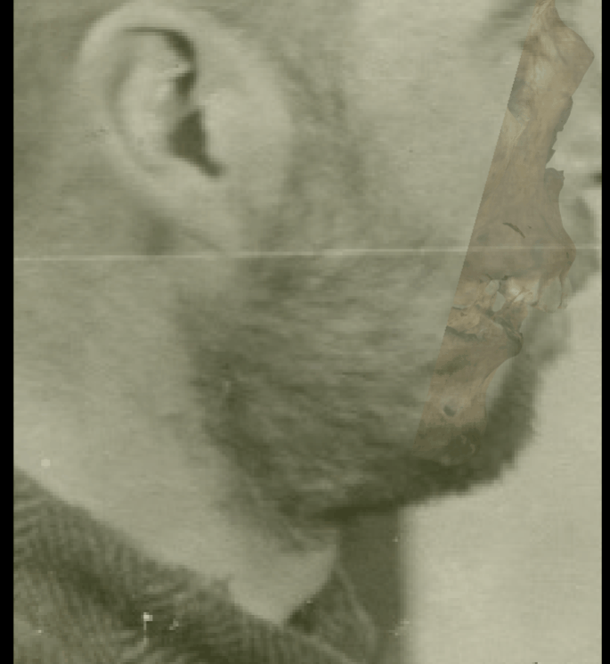 Example of a positive match in which the gonial outline is evaluated with the transparency and wipe tools, showing that the gonial outline follows the outline of the jaw in a consistent way. The wipe tool has been used to show a gradient from the chin to the jaw angle showing a concordance between the two anatomical structures
