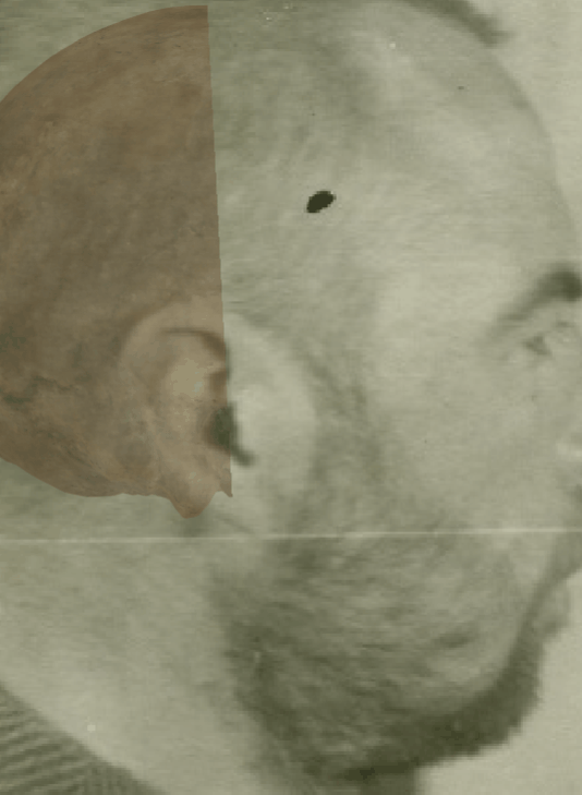 Example of a negative match in which the gonial outline is evaluated with the transparency and wipe tools, showing that the gonial outline does not follow the outline of the jaw in a consistent way. The wipe tool has been used to show a gradient from the mastoid process to the chin showing that the chin protrudes from the facial contour and the jaw angle is not consistent