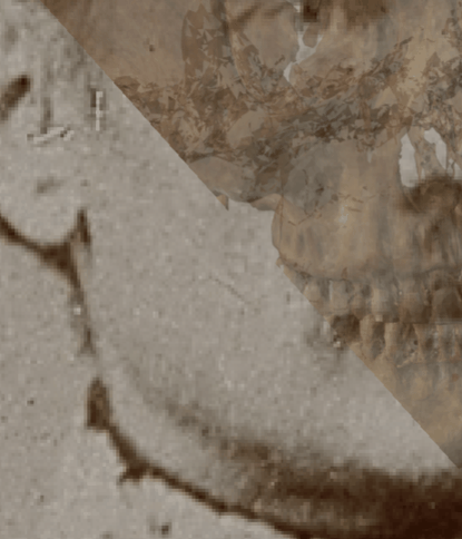 Example of a positive match in which the gonial outline is evaluated with the transparency and wipe tools, showing that the gonial outline follows the outline of the jaw in a consistent way. The wipe tool has been used to show a gradient from the chin to the jaw angle showing a concordance between the two anatomical structures
