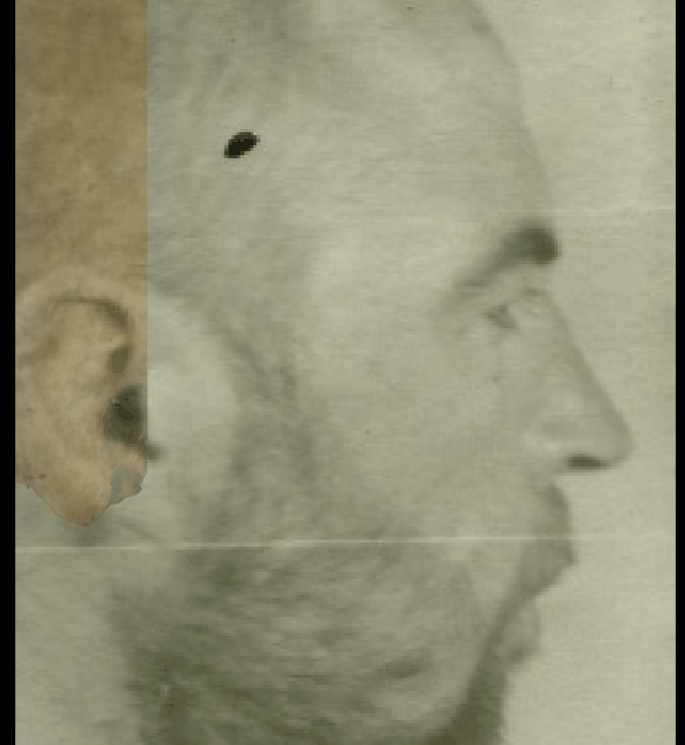 Example of a positive match in which the frontal process of the zygomatic arch and the zygomatic arch are evaluated with the transparency and wipe tools, showing that the frontal process can be aligned with the process in the face and the outline of the zygomatic arch can be fitted between the skull and the face in a consistent way. The wipe tool has been used to show a gradient from the mastoid process to the frontal process of the zygomatic bone