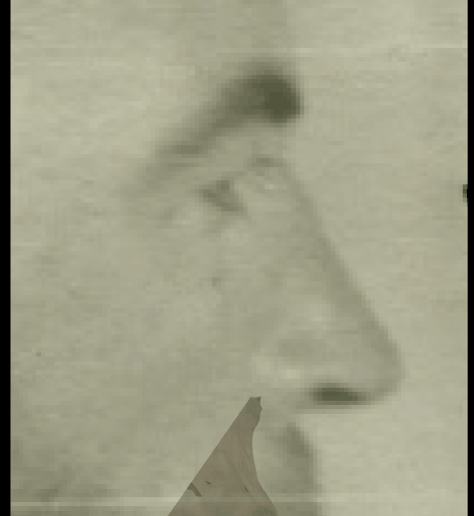 Example of a positive match in which the outline of the nasal bone is evaluated with the transparency and wipe tools, showing that the outline of the nasal bone follows the outline of the nose in the skull with minimal tissue thickness allowance in a consistent way. The wipe tool has been used to show a gradient from the nasal spine to nasion showing consistency in the outlines of both anatomical structures