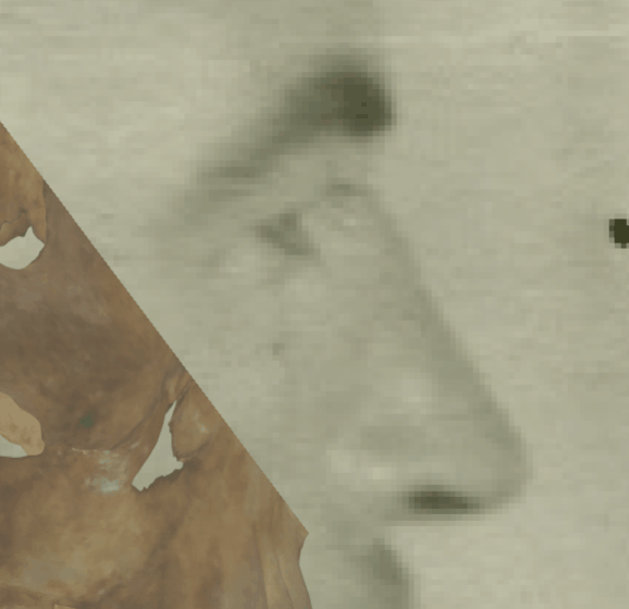 Example of a negative match in which the outline of the nasal bone is evaluated with the transparency and wipe tools, showing that the outline of the nasal bone does not follows the outline of the nose in the skull with minimal tissue thickness allowance in a consistent way. The wipe tool has been used to show a gradient from the nasal spine to nasion showing inconsistency in the outlines of both anatomical structures. In this case the nasal bone morphology is different from the nose in the face and protrudes over the nose contour