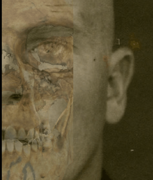 Example of a positive match in which the lateral line of the zygomatic bone is evaluated with Skeleton·ID by means of the transparency and wipe tools, showing that the lateral line of the zygomatic bone matches the lateral line of the cheek in the face