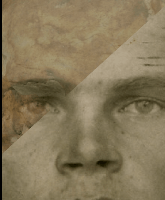 Example of a positive match in which the outline of the nose is evaluated with Skeleton·ID by means of the transparency and wipe tools, showing that the outline of the nasal bone maintains a symmetrical flow on both sides with the outline of the nose in the photograph in a consistent way. The wipe tool has been used to show a gradient from top to bottom and from left to right of the nasal bone over the nose