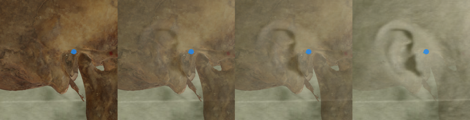 Example of a negative match in which the position of the right porion is visually evaluated with Skeleton·ID by means of the transparency tool, showing that the right porion does not align posterior to the tragus, in this case is located in an upper right area. The transparency tool has been used to show a gradient of opacity of the auditive meatus showing the position of the porion over the ear