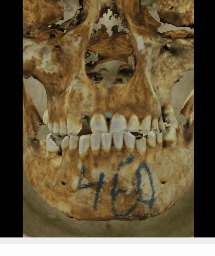 Example of a positive match in which the prosthion position is evaluated with the transparency tool, showing that the prosthion lies posterior to the anterior edge of the upper lip (cupid’s bow) in a consistent way. The transparency tool has been used to show a gradient of opacity over the teeth showing that the prosthion in the skull is positioned in the anterior edge of the upper lip in the face