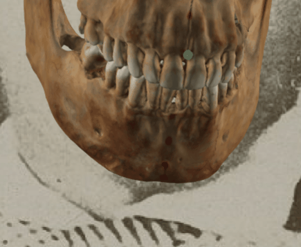 Example of a positive match in which the position of the prosthion is visually evaluated with Skeleton·ID by means of the transparency tool, showing that the prosthion lies posterior to the anterior edge of the upper lip in a consistent way. The transparency tool has been used to show a gradient of opacity of the teeth over the mouth