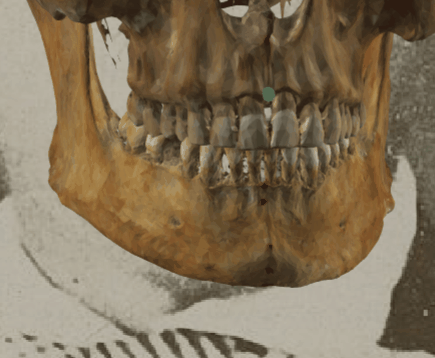 Ejemplo de un solapamiento negativo en vista oblicua en la que se evalúa la posición del prosthion con Skeleton·ID mediante la herramienta de transparencia, mostrando que el prosthion (punto verde) no se sitúa sobre el borde anterior del labio superior de manera consistente. La herramienta de transparencia se ha utilizado para mostrar un gradiente de opacidad sobre la boca mostrando la posición de prosthion en relación al labio superior. En este caso, se puede observar como prosthion se sitúa en el margen lateral del surco nasolabial