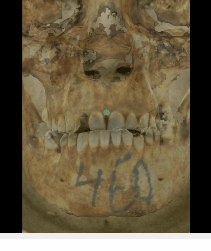Example of a negative match in which the prosthion position is evaluated with the transparency tool, showing that the prosthion does not lie posterior to the anterior edge of the upper lip (cupid’s bow) in a consistent way. The transparency tool has been used to show a gradient of opacity over the teeth showing that the prosthion in the skull is positioned some mms above the anterior edge of the upper lip in the face
