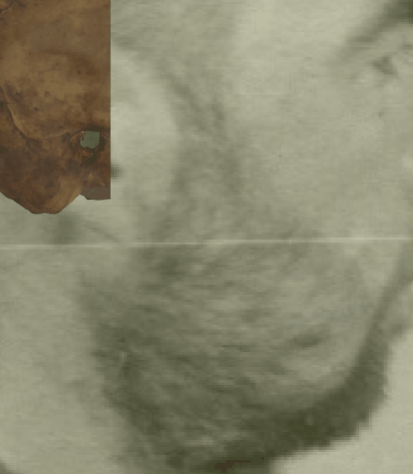 Example of a negative match in which the position of the gonial flare is visually evaluated with Skeleton·ID by means of the transparency and wipe tools, showing that the gonial flare in the skull and the postero-lateral jaw prominence in the face are inconsistent. The wipe tool has been used to show a gradient of the right jaw